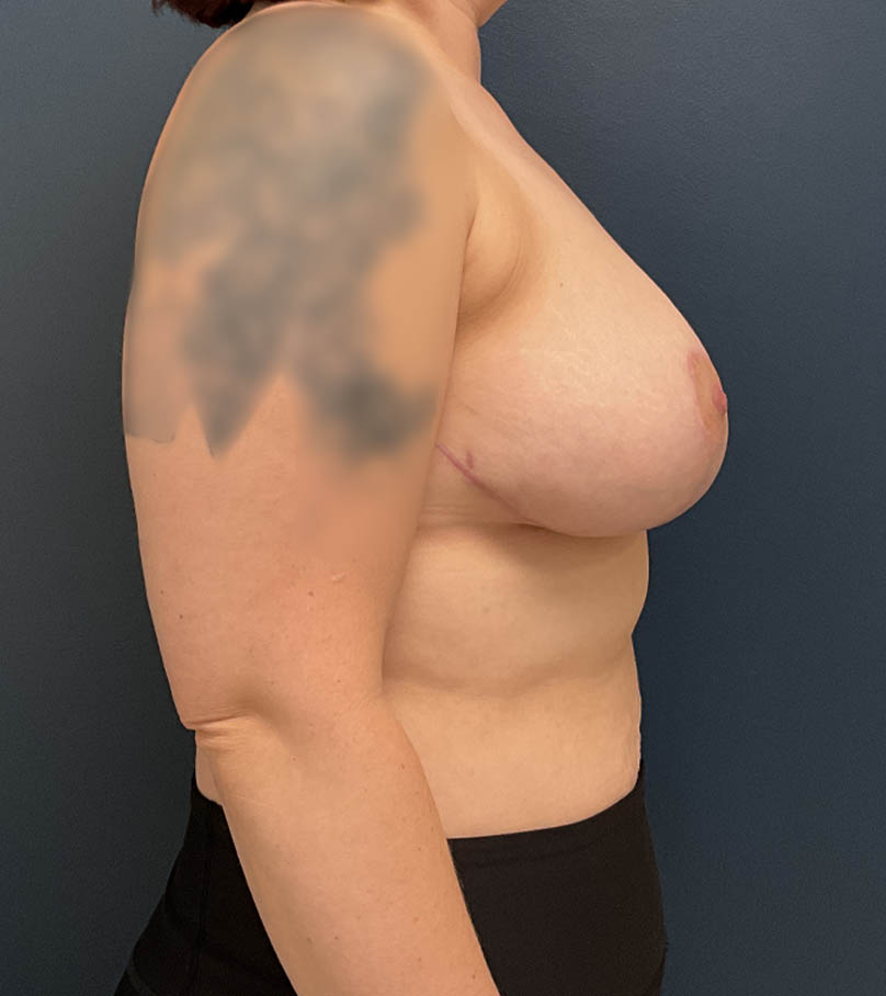 Breast Lift case #21144