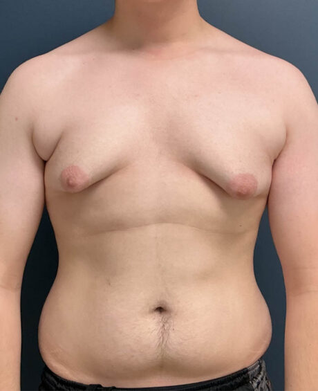 Gynecomastia case #21128