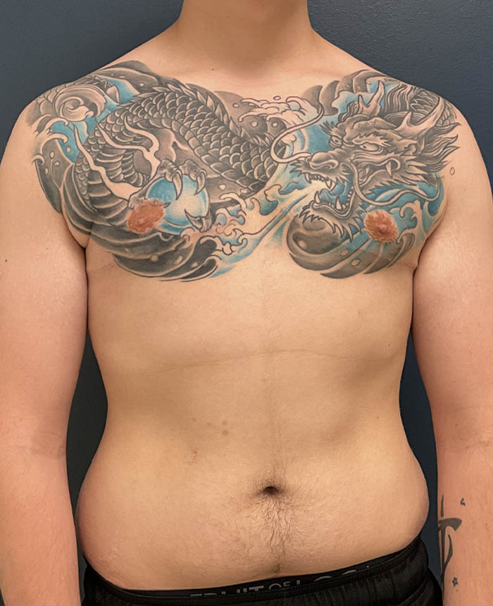 Gynecomastia case #21128