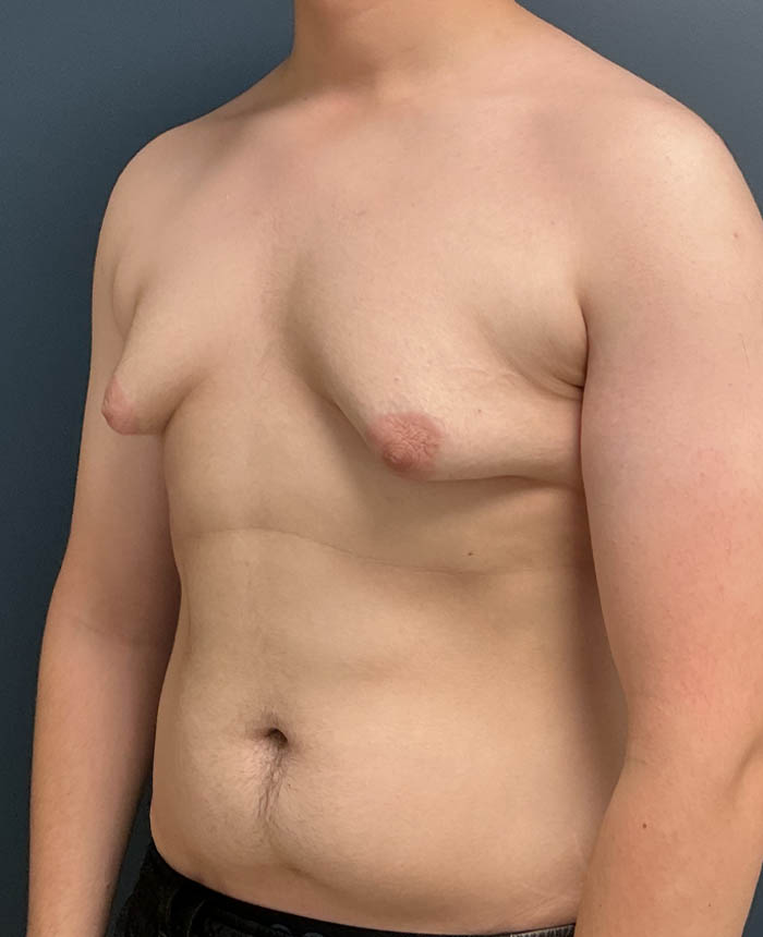 Gynecomastia case #21128