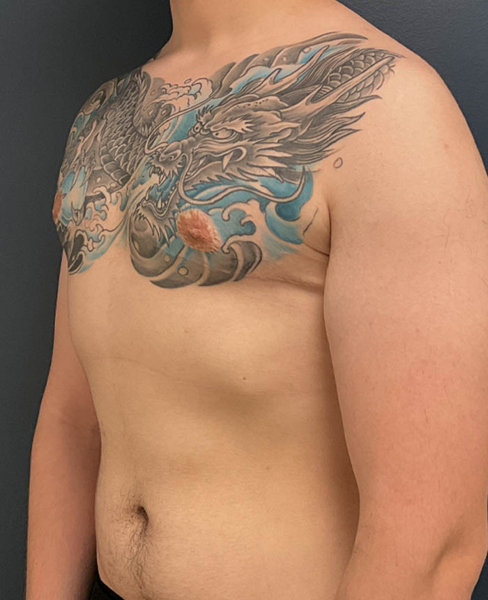 Gynecomastia case #21128