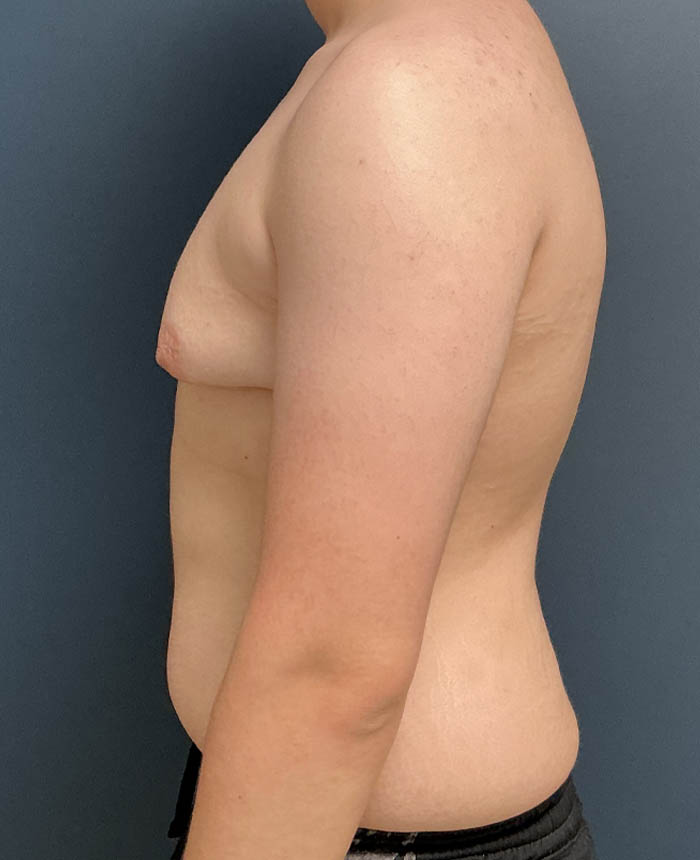 Gynecomastia case #21128