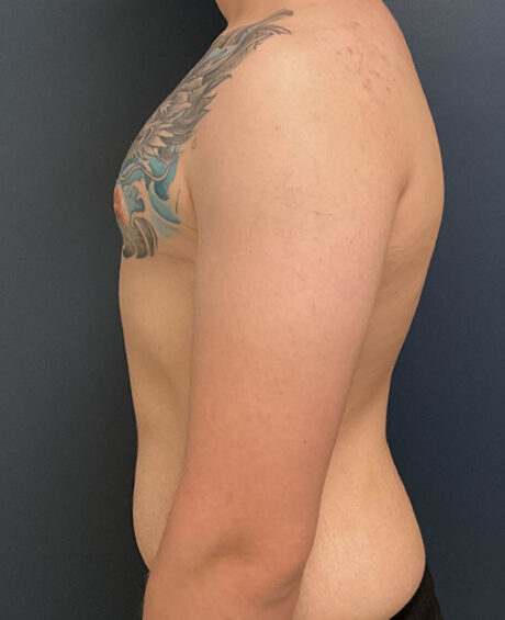 Gynecomastia case #21128