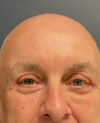Eyelid Surgery case #21120