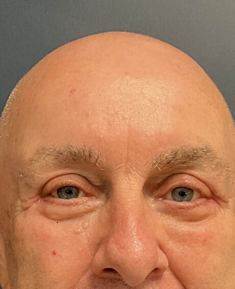 Eyelid Surgery case #21120