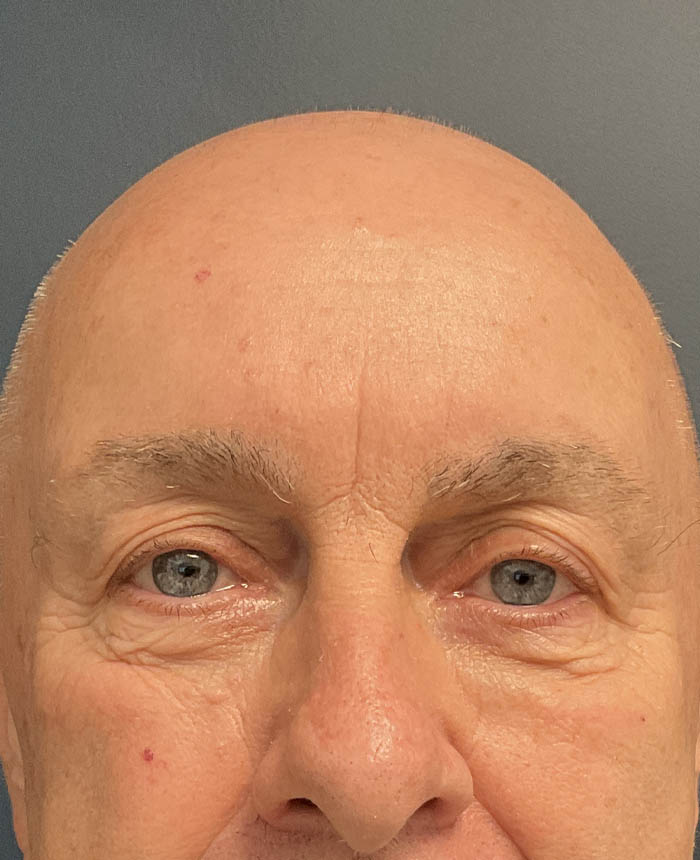 Eyelid Surgery case #21120