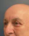 Eyelid Surgery case #21120