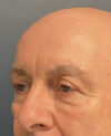 Eyelid Surgery case #21120