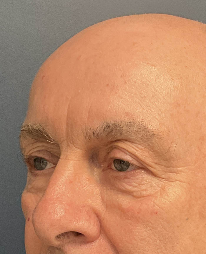 Eyelid Surgery case #21120