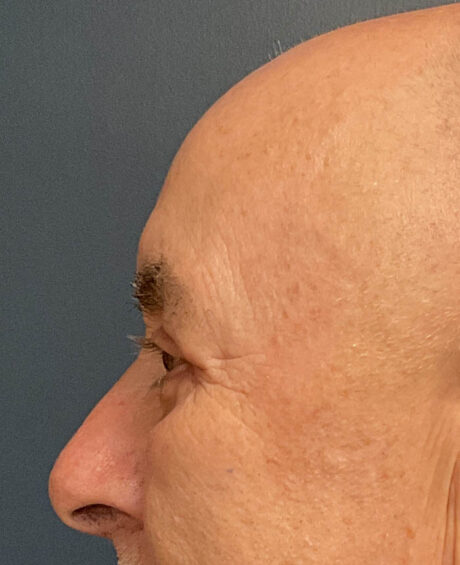 Eyelid Surgery case #21120