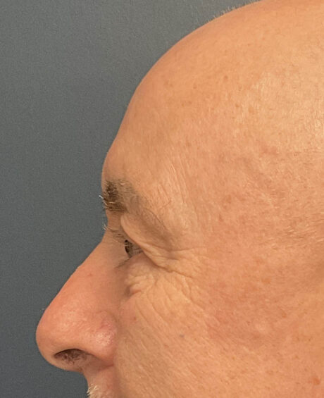 Eyelid Surgery case #21120