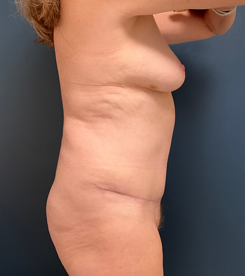 Tummy Tuck case #21102
