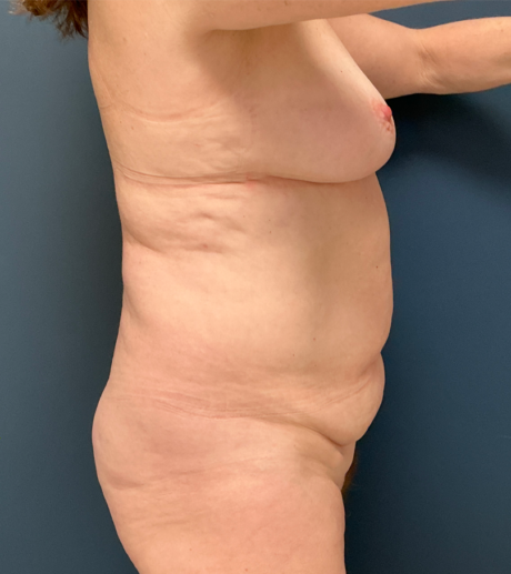 Tummy Tuck case #21102