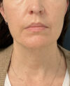 Facelift case #21194