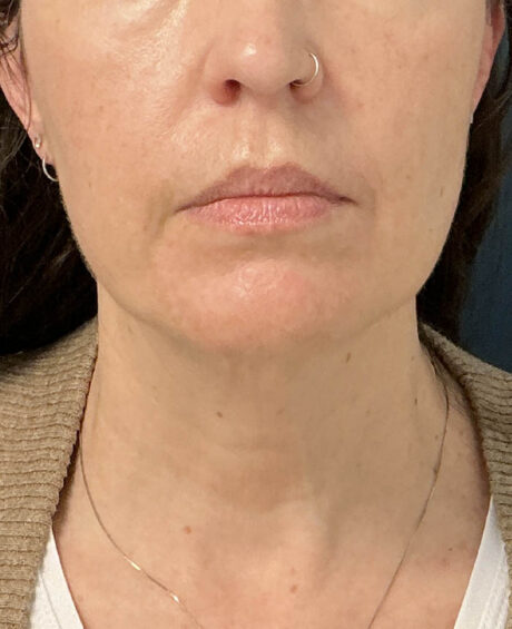 Facelift case #21194