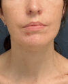 Facelift case #21194