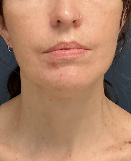 Facelift case #21194