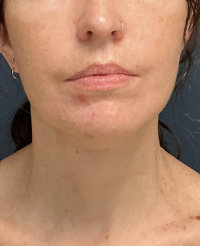 Facelift case #21194