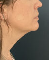 Facelift case #21194