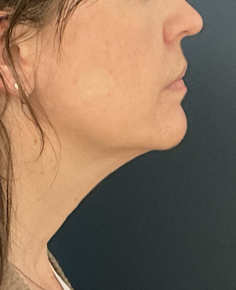 Facelift case #21194