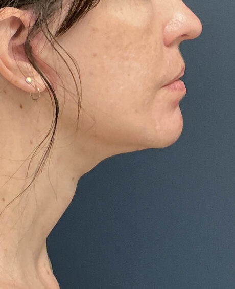 Facelift case #21194