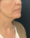 Facelift case #21194