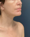 Facelift case #21194