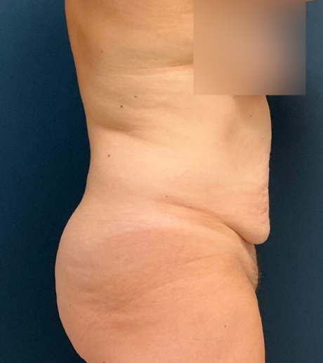 Tummy Tuck case #21183