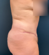 Tummy Tuck case #21183